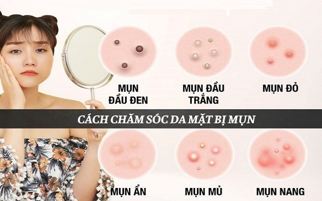 Cách chăm sóc da mặt bị mụn cho mọi loại da - Quy trình chuẩn 