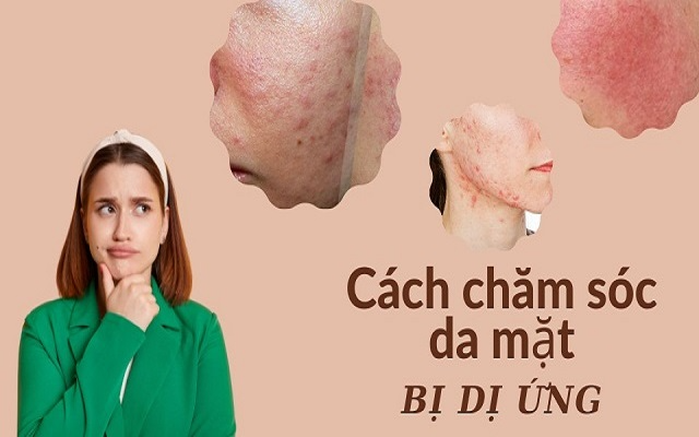 Hướng dẫn cách chăm sóc da mặt bị dị ứng chuẩn da liễu