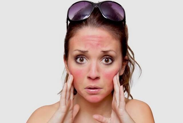Tiếp xúc ánh nắng cực gắt có thế làm bỏng da