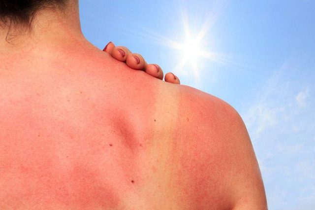  Tia UVB có khả năng làm cháy da, đỏ da